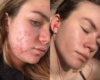 Before and after photos of a person with acne. Left: acne. Right: clear skin.