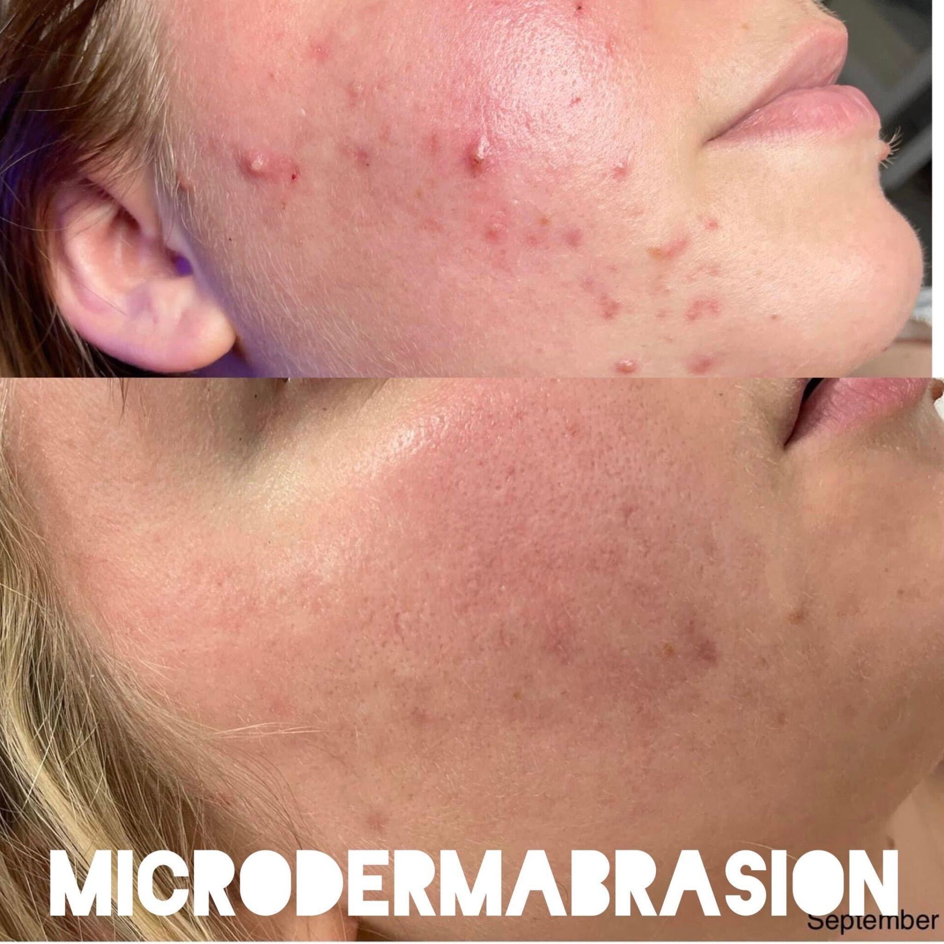 Before and after comparison of a person's face after microdermabrasion. Acne is reduced and skin appears smoother.