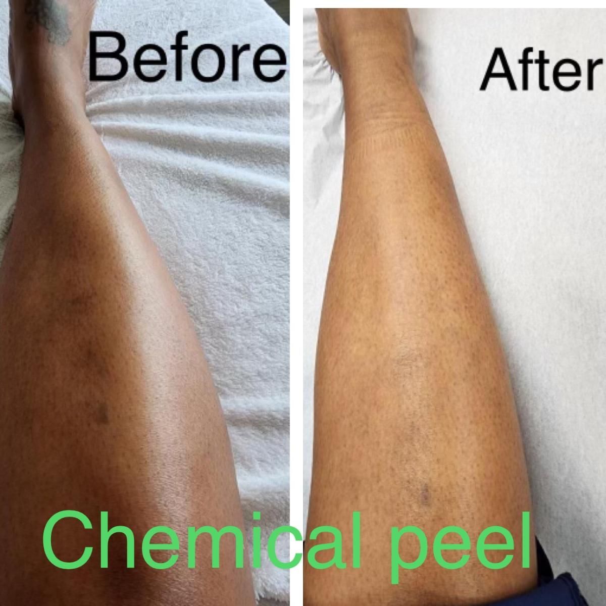 Comparison of a leg before and after a chemical peel, showing skin discoloration reduction.