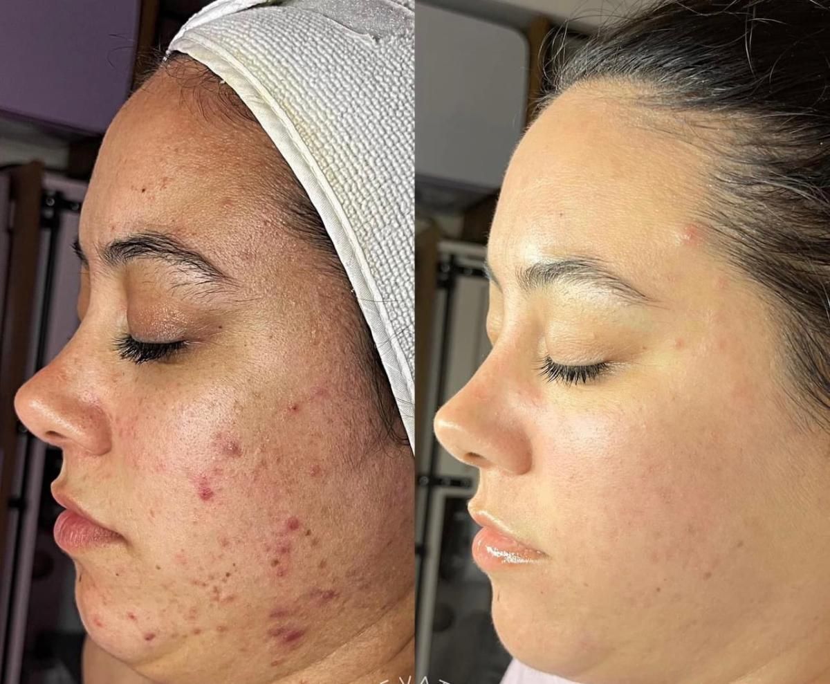 Side-by-side view of a person's face. Left side: acne. Right side: clear skin. Both sides show profile view with closed eyes.