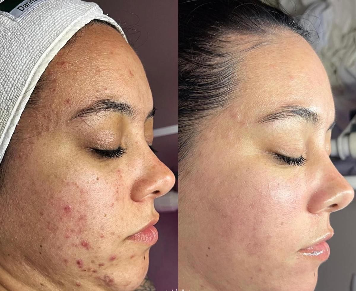 Before-and-after facial comparison: acne-prone skin on left, improved skin on right, both close-up profile views.