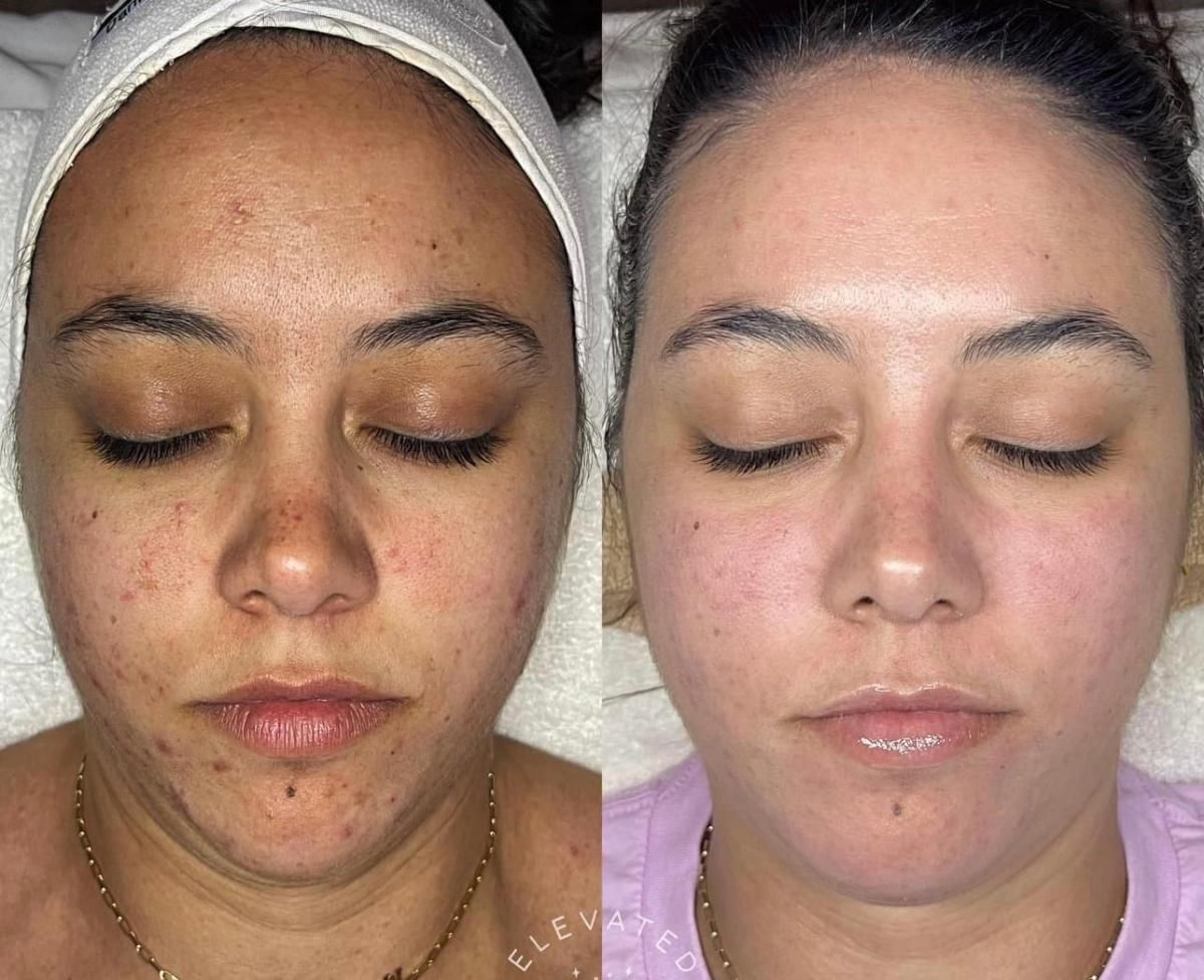 Before and after comparison of a person's facial skin. Acne and blemishes are reduced in the after photo.