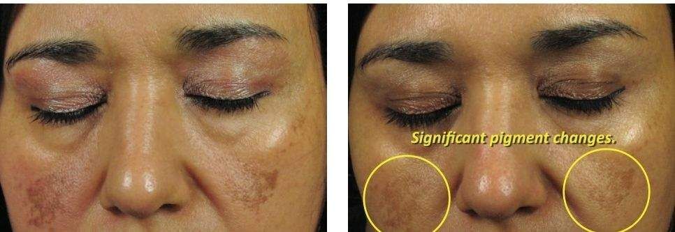 Comparison of skin before and after treatment, showing changes in pigmentation on cheeks.