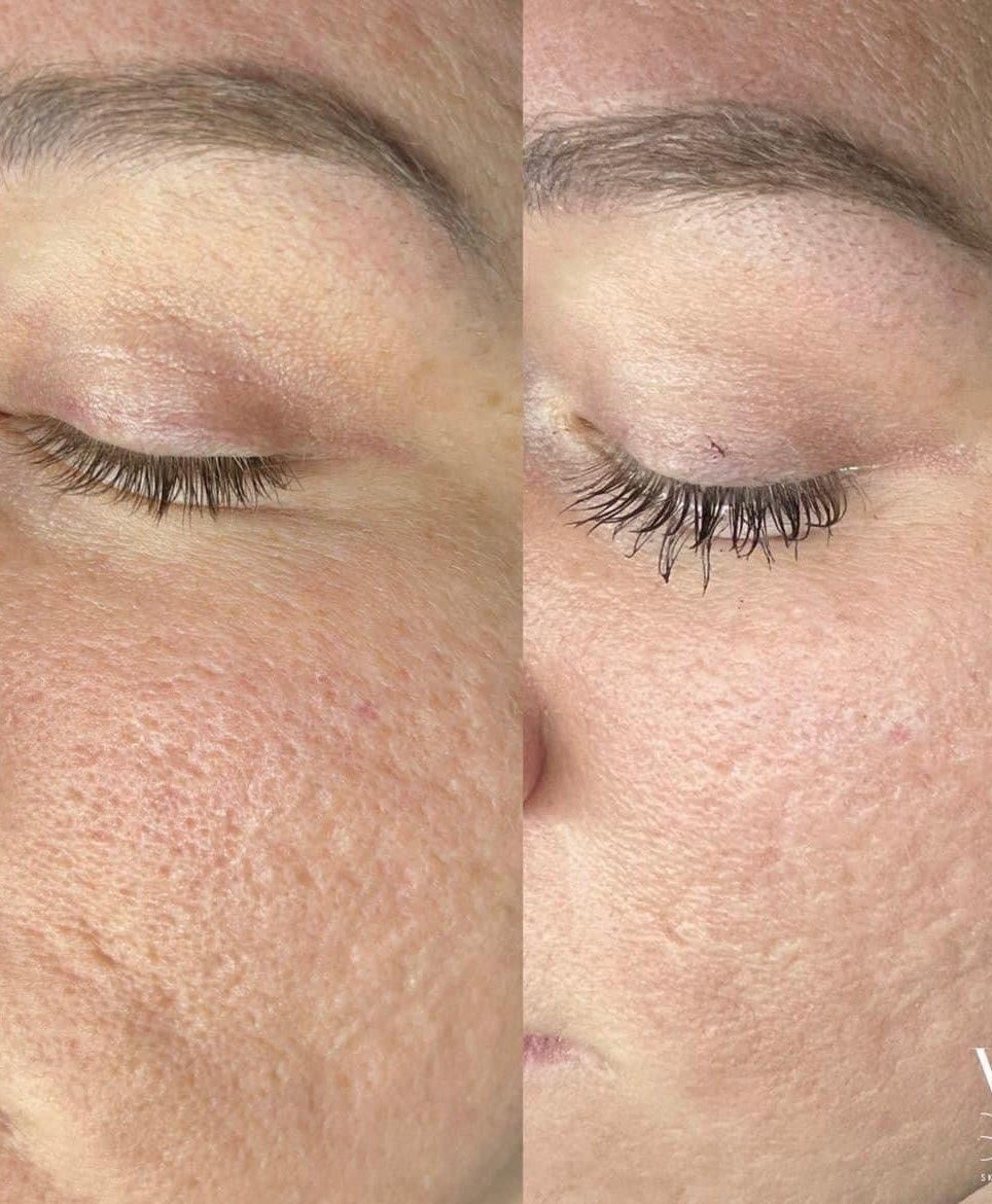Comparison of facial skin before and after treatment, showing reduction in texture and scarring.