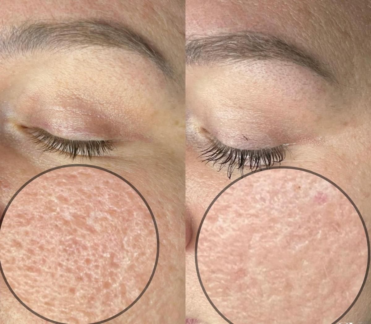 Before and after comparison of facial skin texture, showing reduced pore size.