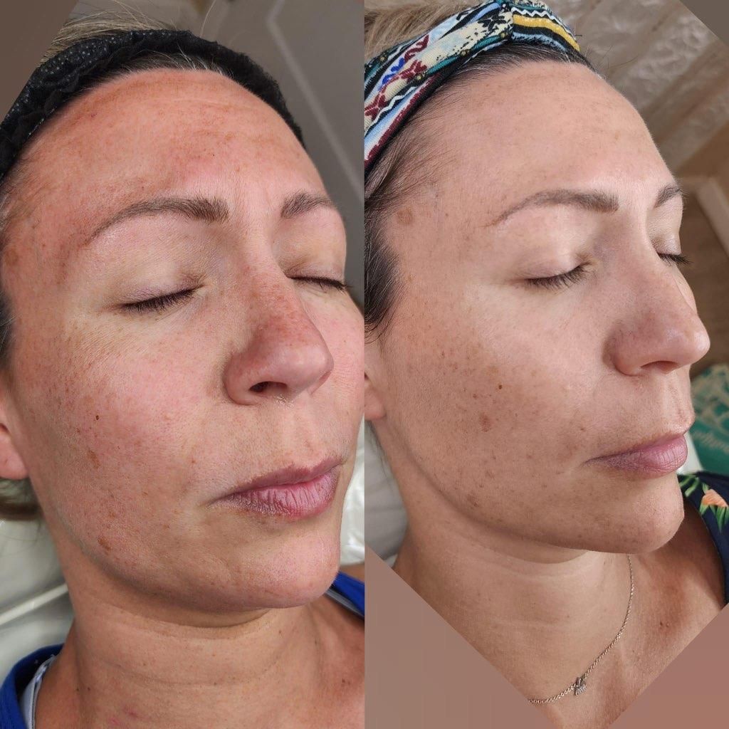 Before and after photos of a woman's face, showing a reduction in dark spots and redness after a treatment.