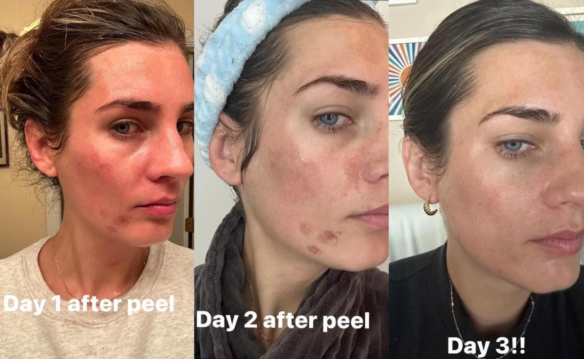 Three photos show a woman's face after a peel: Day 1 with redness, Day 2 with dark spots, and Day 3