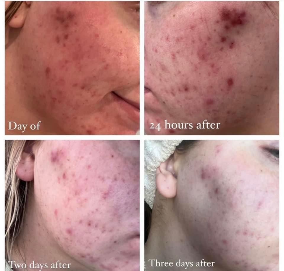 Progression of acne on a face over 3 days. Shows inflammation and reduction of acne over time.