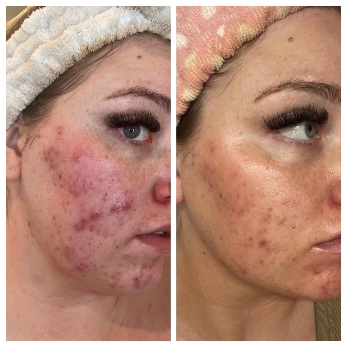 Before and after comparison of a person's face showing acne reduction; redness, blemishes, and a headband.