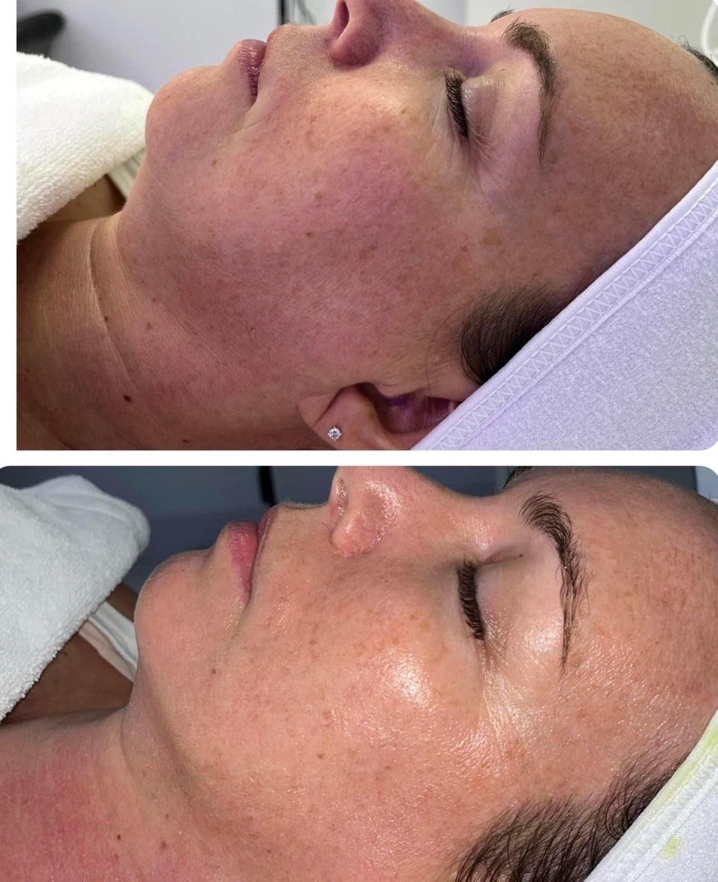 Comparison of a woman's face before (top) and after (bottom) a skin treatment, showing a reduction in redness