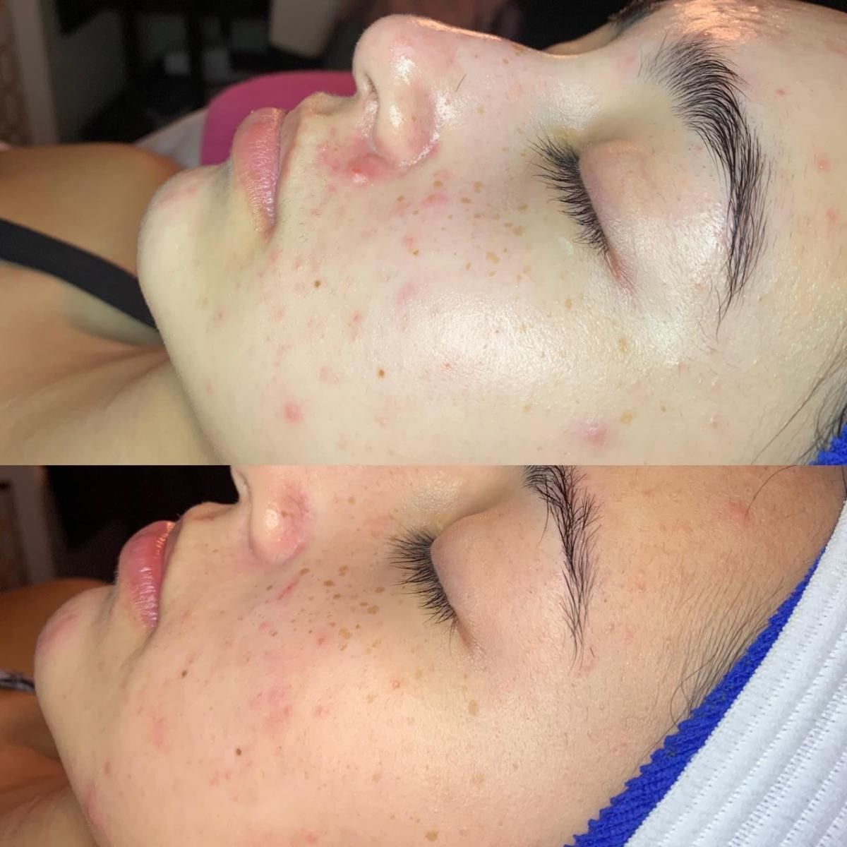 Before and after images of a person's face showing reduction in acne.