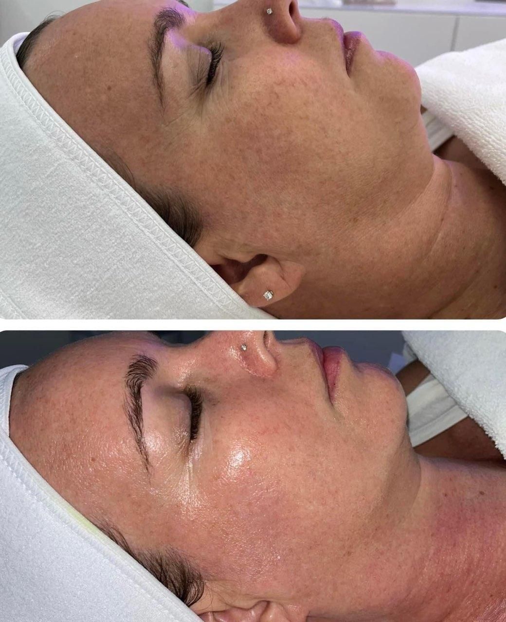 Before and after facial treatment: top photo, skin with imperfections; bottom, smoother, clearer skin.