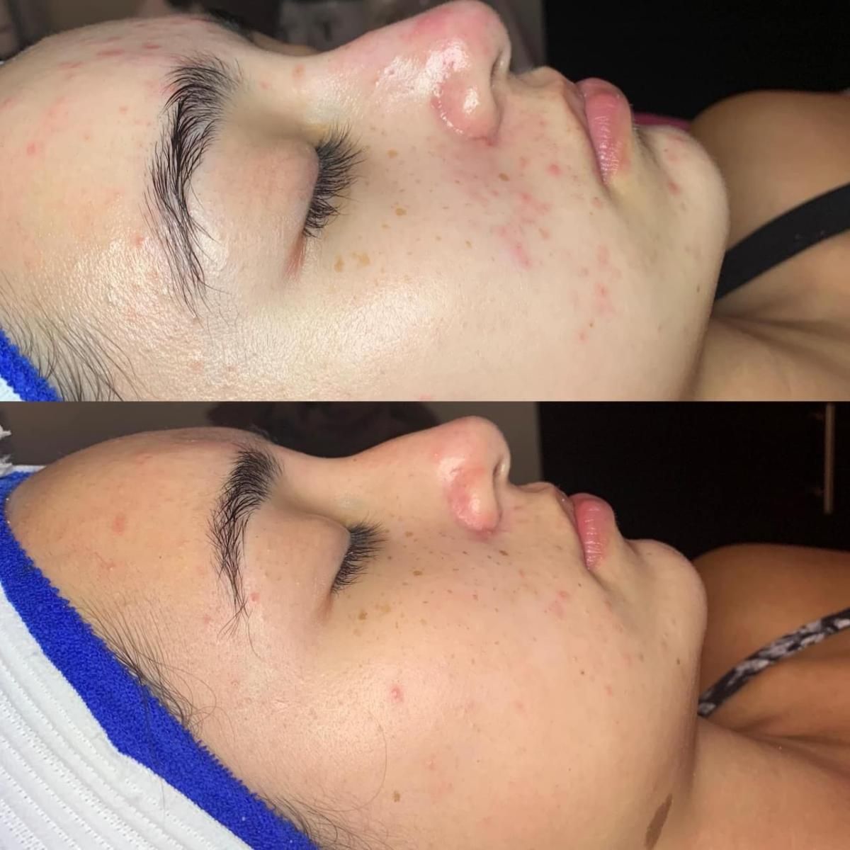 Before-and-after of a person's face. The top image shows visible red spots. The bottom shows improvement with less redness.