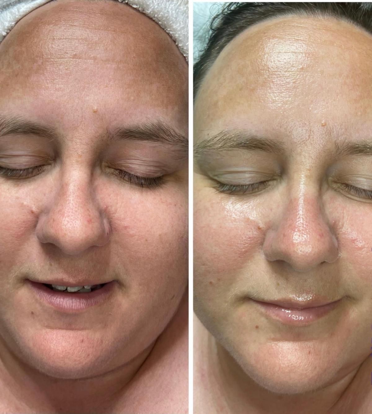 Two images of a person's face side-by-side, showing skin tone improvement.