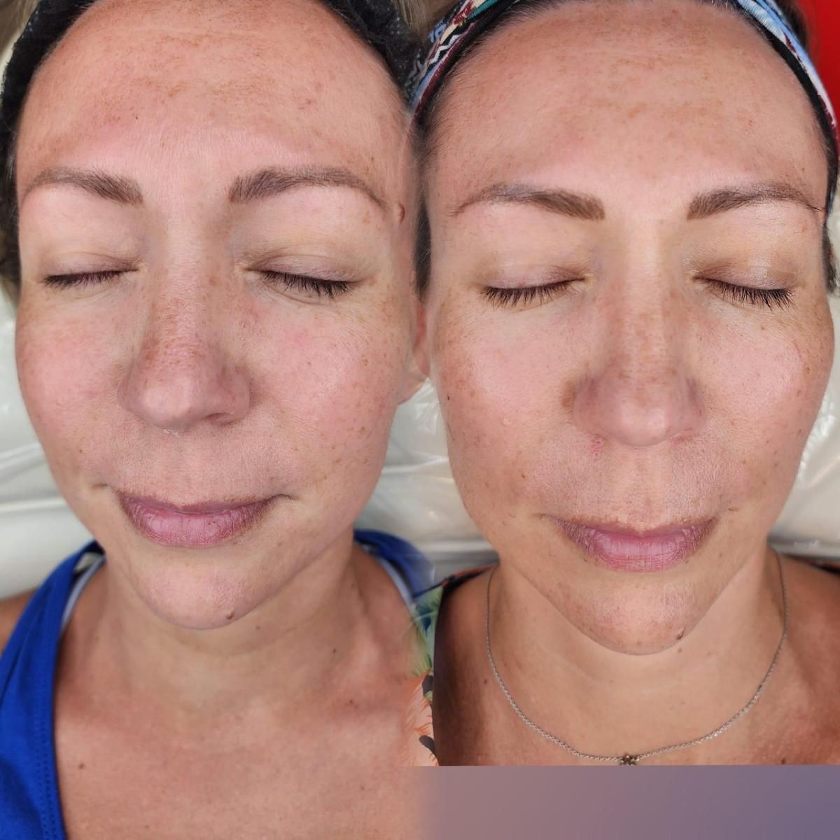 Before and after photos showing skin treatment results. Face on the left has more blemishes.
