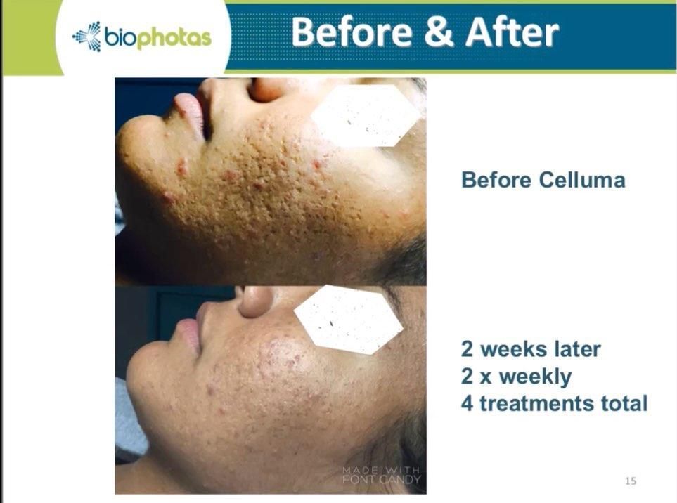 Comparison of a person's skin before and after Celluma treatments, showing a reduction in acne.