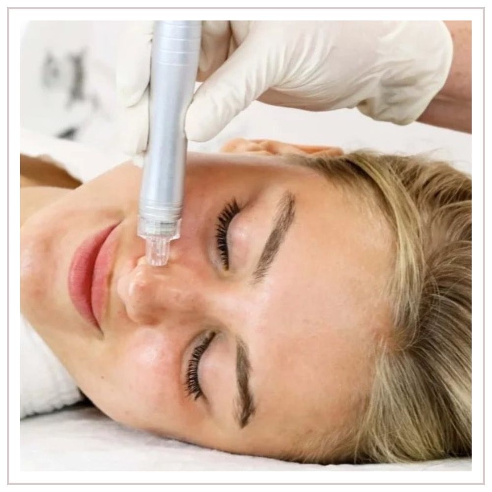 Facial microneedling treatment in progress on a woman's nose; close-up view.