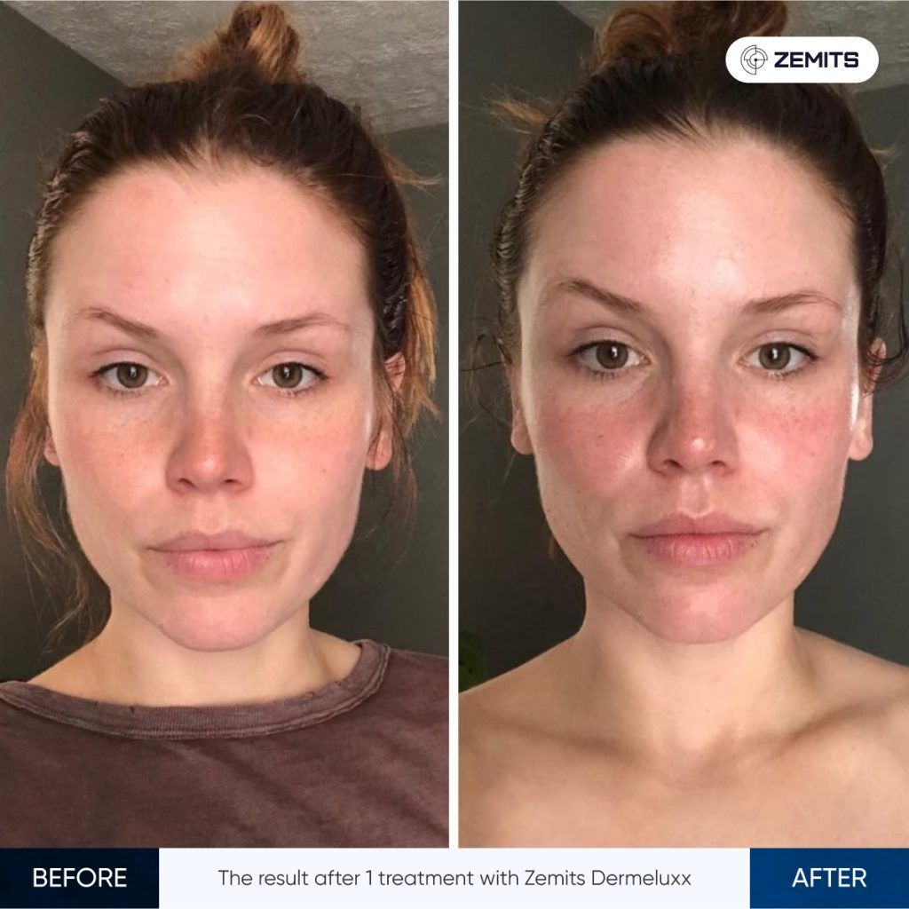 Side-by-side comparison of a person's face. Left side: before, Right side: after 1 treatment.