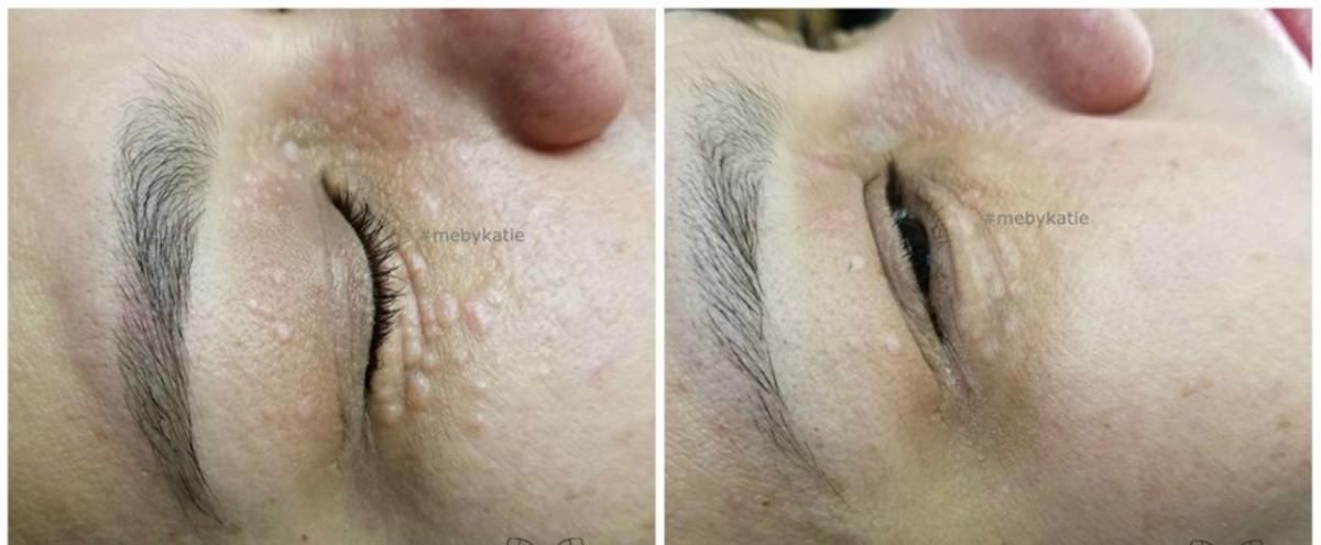 Side-by-side comparison of an eyelid with small bumps before and after a treatment, showing smoother skin.