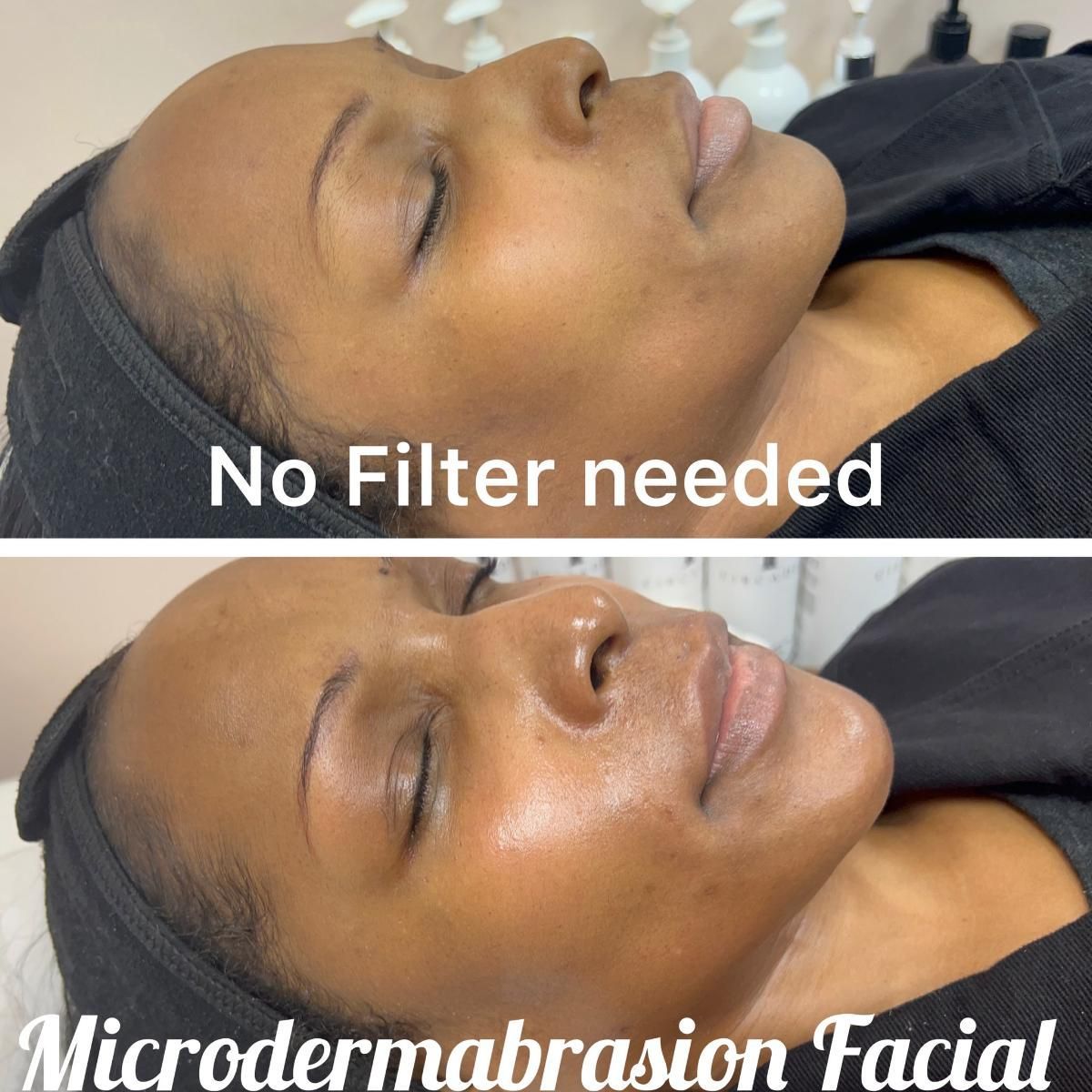 Two side-by-side facial images, before and after a microdermabrasion treatment. Skin appears smoother.