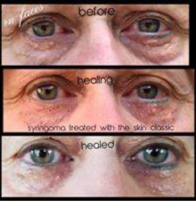 Before-and-after of eyes with syringoma. Redness and discoloration improve after treatment with the skin classic.