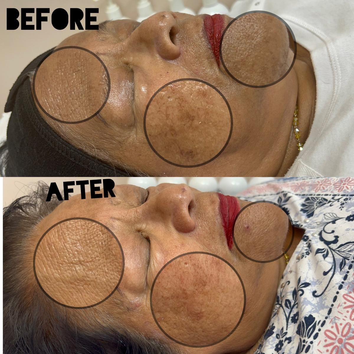 Before and after view of a person's face showing reduction in skin discoloration.