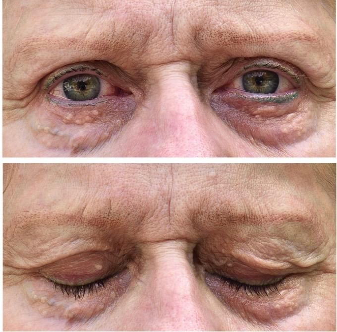 Two eye views: open and closed, showing multiple small, yellowish bumps under and around the eyes.