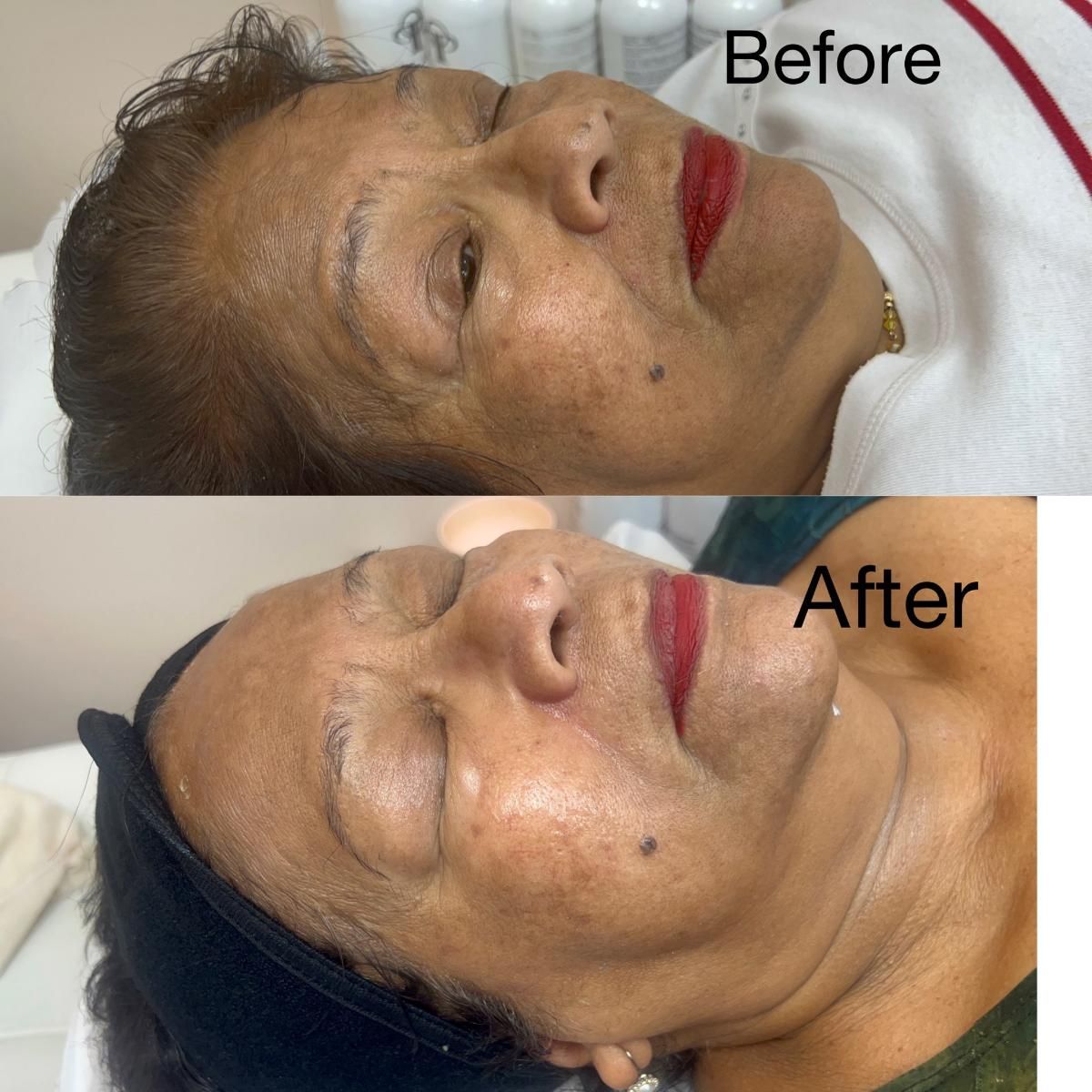 Side-by-side photos of a woman's face: Before and After facial treatment. Skin appears brighter after.