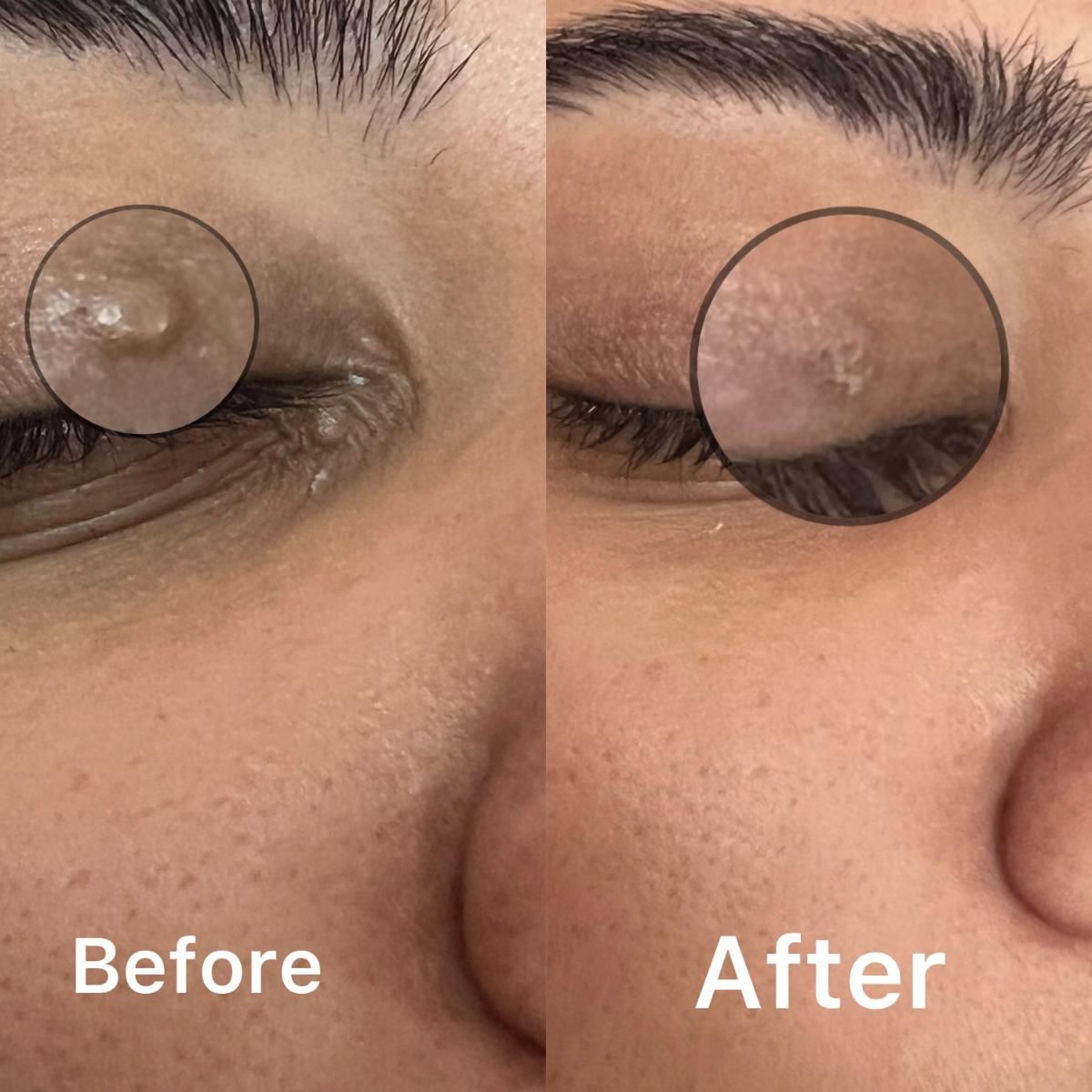 Close-up of eye area before and after treatment, removing skin growth near eyelid.
