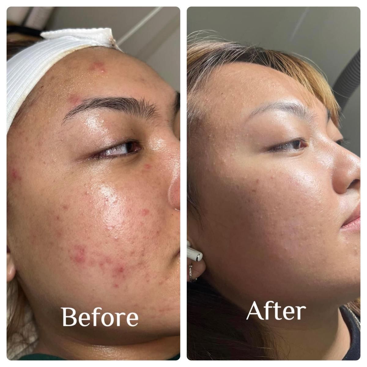 Side-by-side comparison of a person's face. Left side shows acne; right side shows improved skin.
