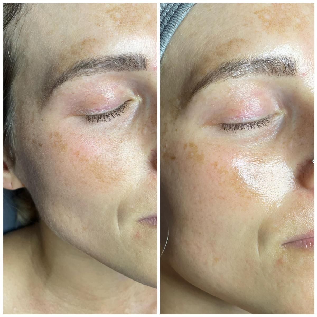 Comparison of a woman's face before and after a skin treatment. Left side is untreated with dark spots.