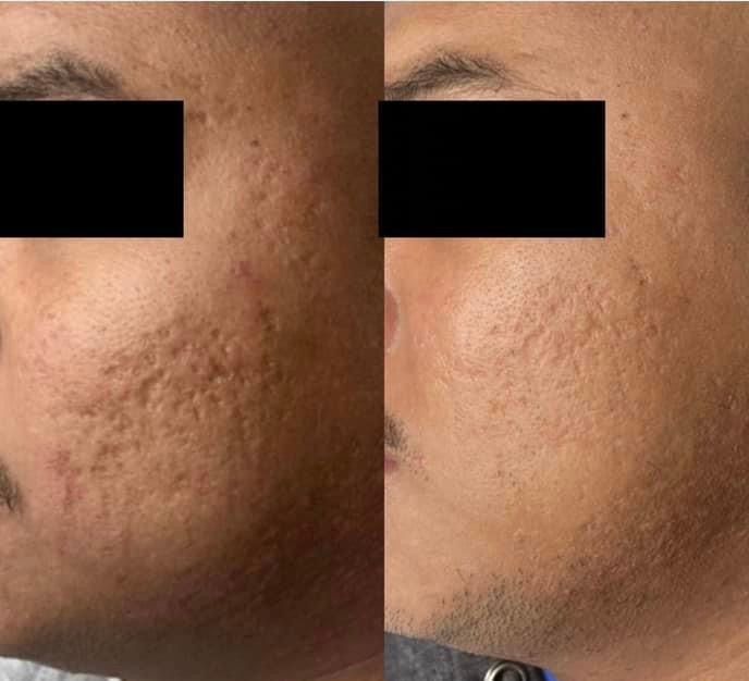 Side-by-side comparison of a person's face. Left side shows acne scars; right side shows improved skin texture.