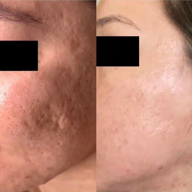 Before and after photos of skin with significant acne scarring, then improved skin texture.