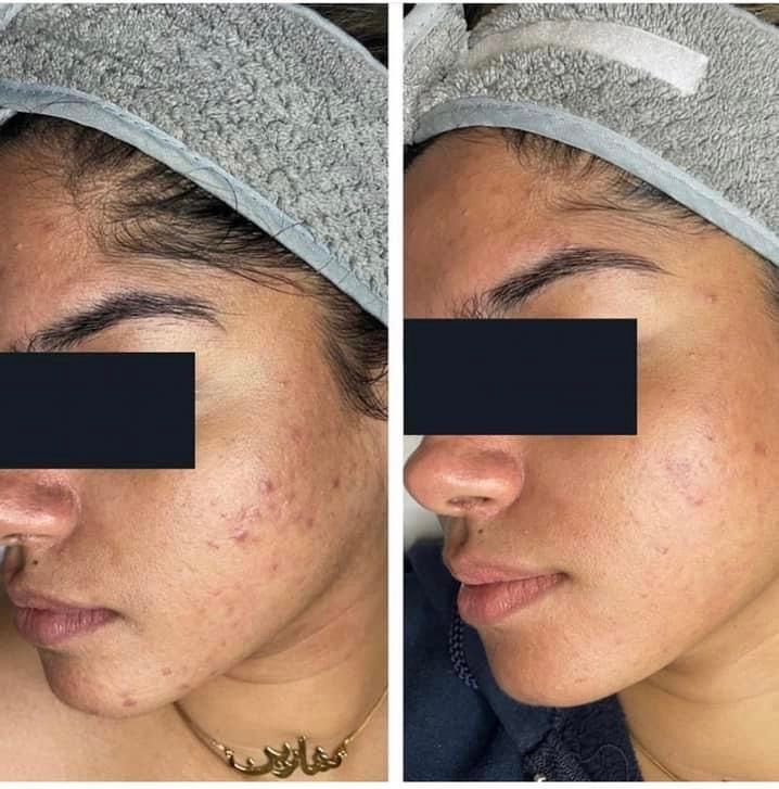 Before and after photos of a person's face. Acne is reduced, skin appears smoother after treatment.