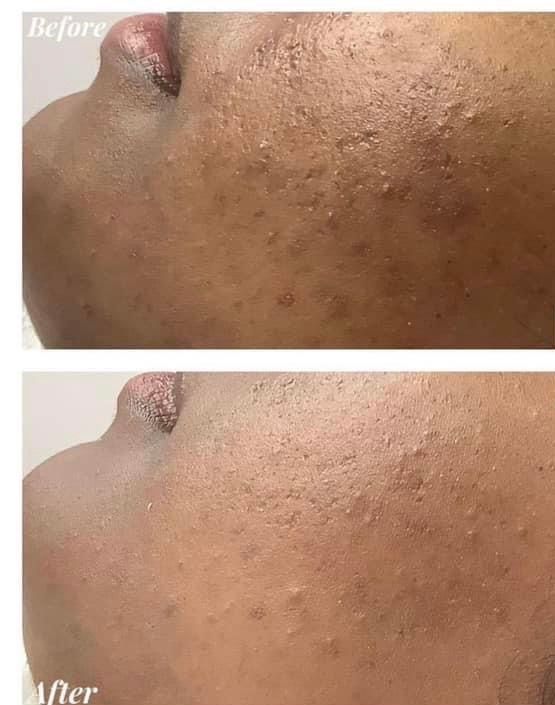 Side-by-side comparison of skin before and after treatment, showing fewer blemishes and smoother texture.