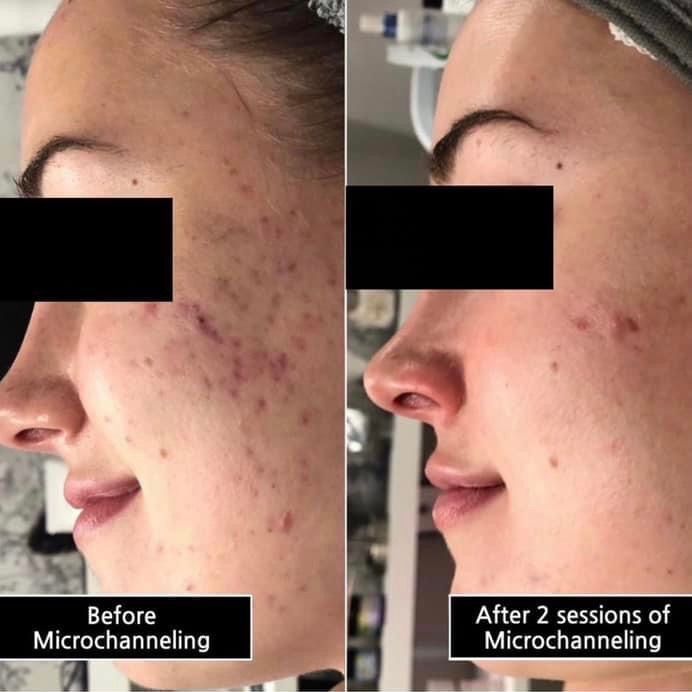 Side-by-side comparison of a person's face. Left side: skin with acne; Right side: skin improvement after microchanneling.