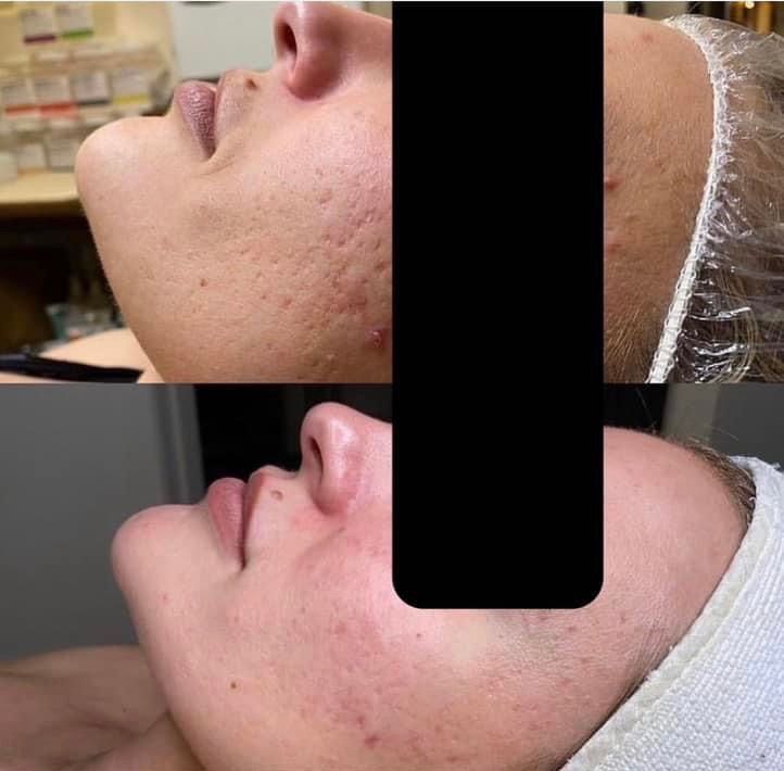Side-by-side view of a face before and after treatment, showing reduction in acne scars.