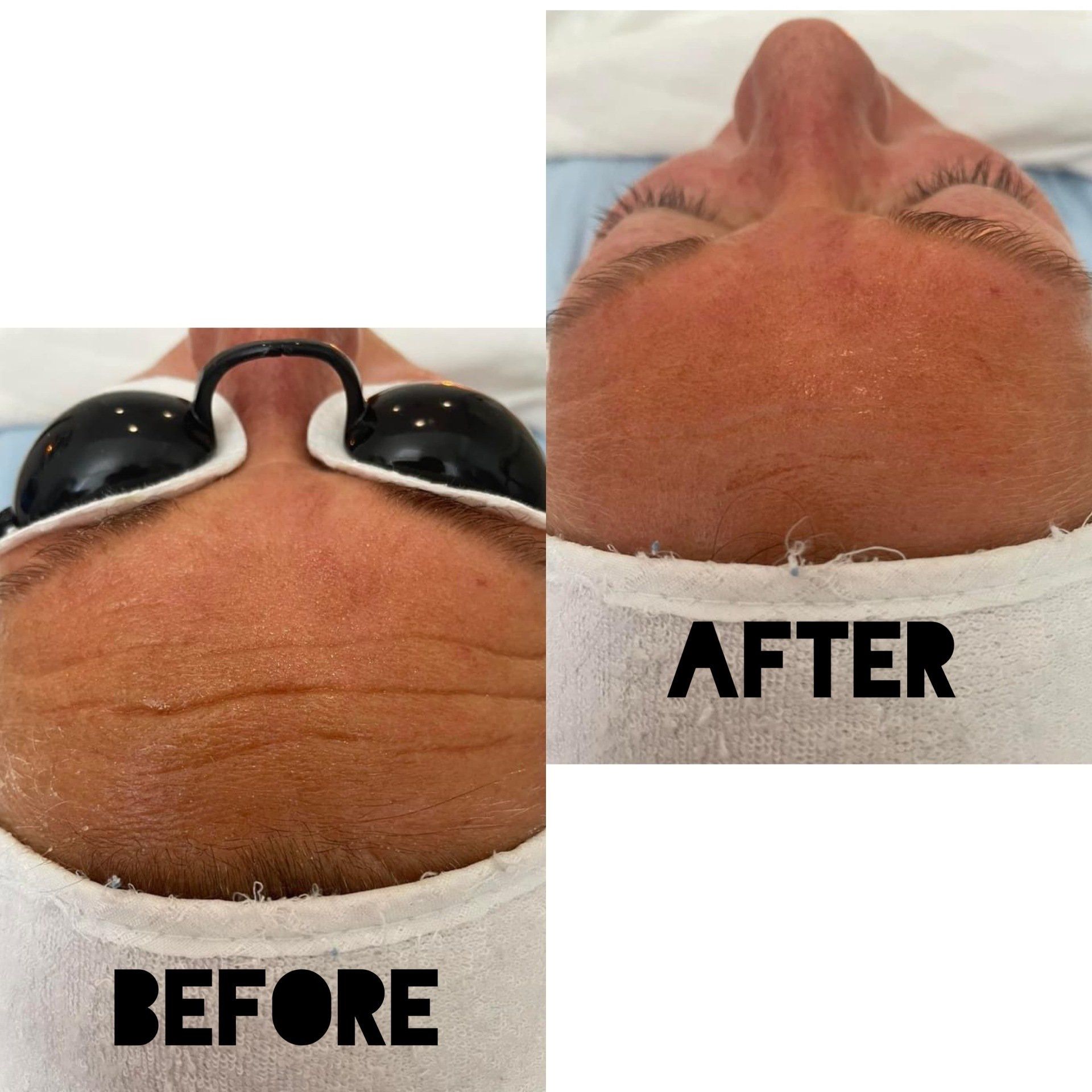 Before and after view of a forehead with wrinkles; after treatment shows smoother skin.