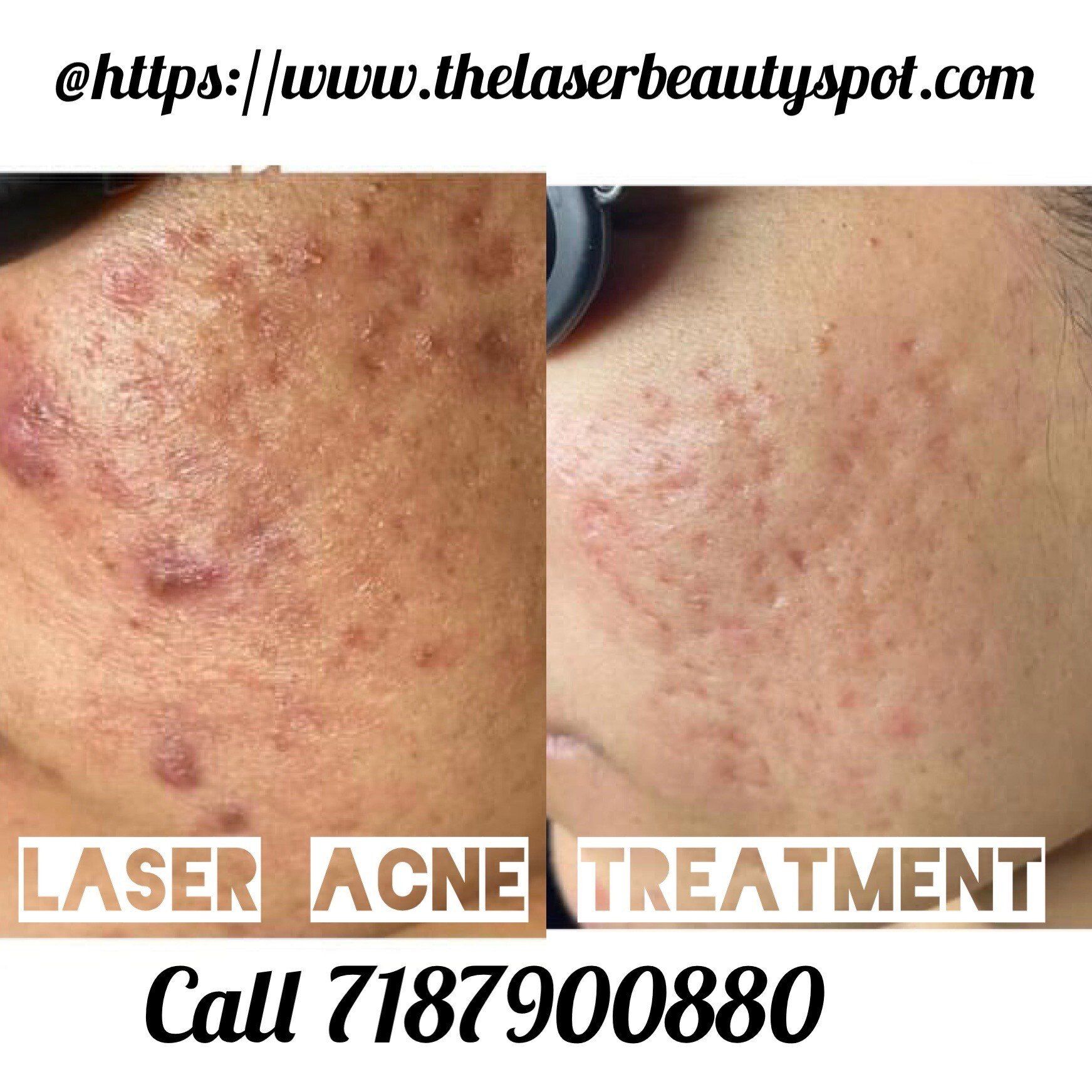Before and after view of a face with acne scars, text 