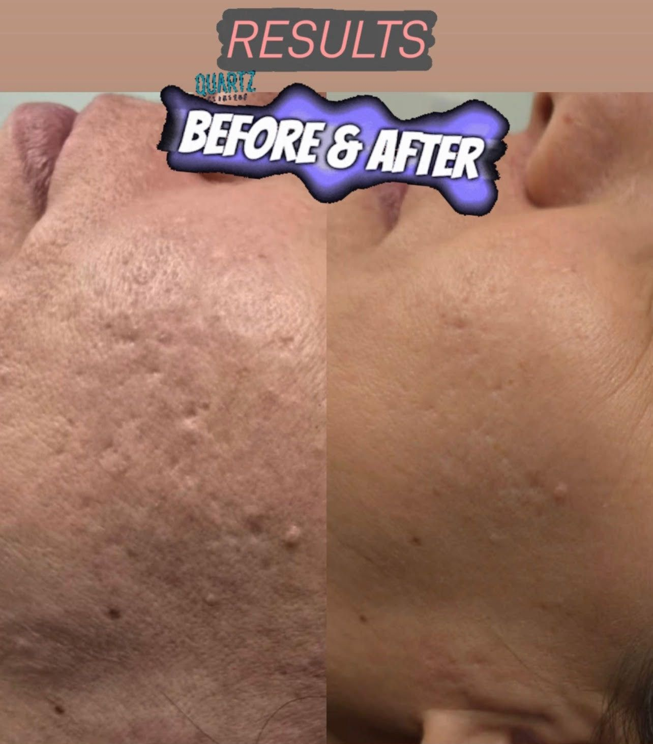 Before & After of facial skin. The left shows bumpy skin with visible pores. The right side shows smoother skin