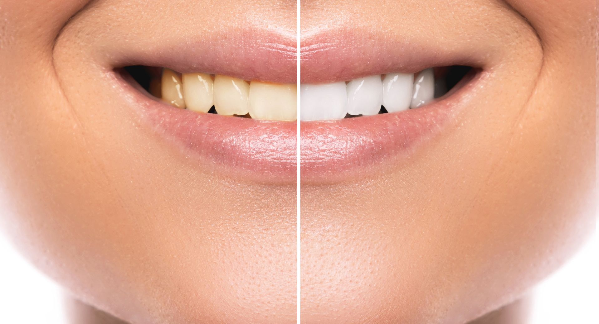 Close-up of a smile showing a side-by-side comparison of teeth before and after whitening. Close-up of a smile showing a side-by-side comparison of teeth before and after whitening.