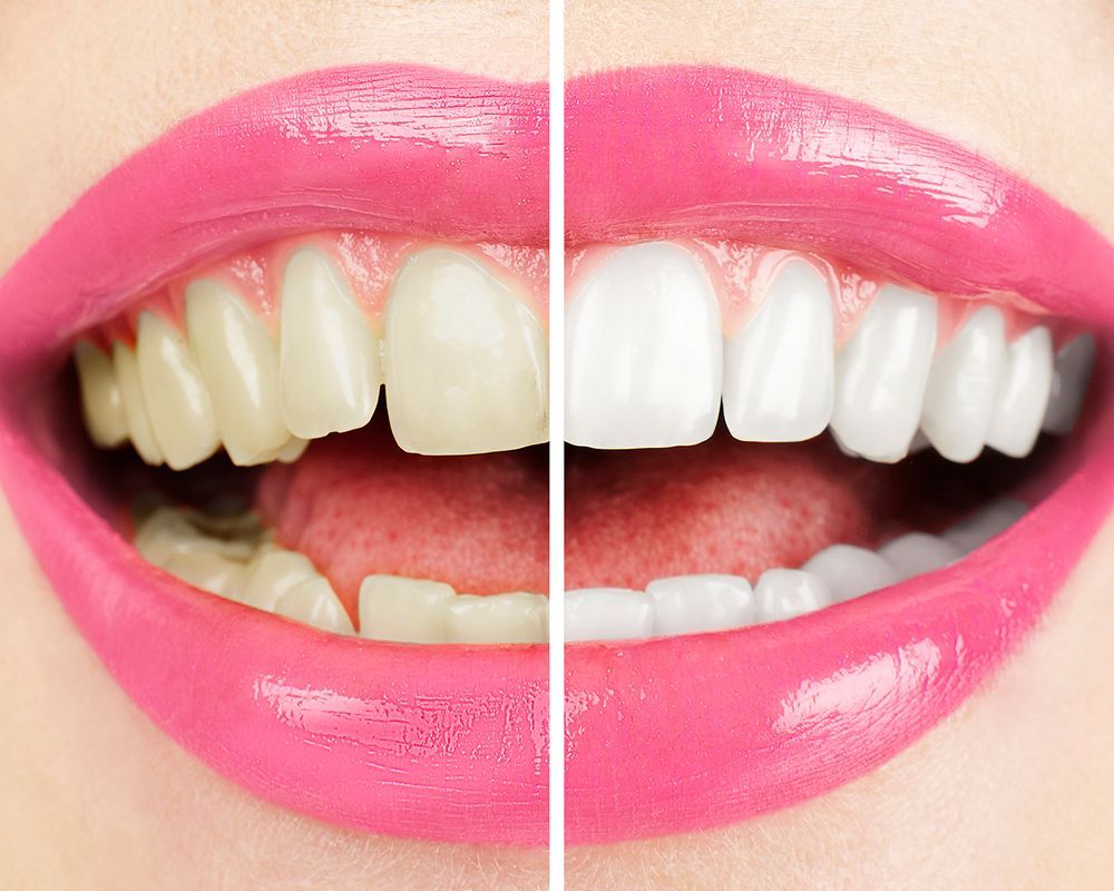 Woman with white teeth after professional teeth whitening Woman with white teeth after professional teeth whitening