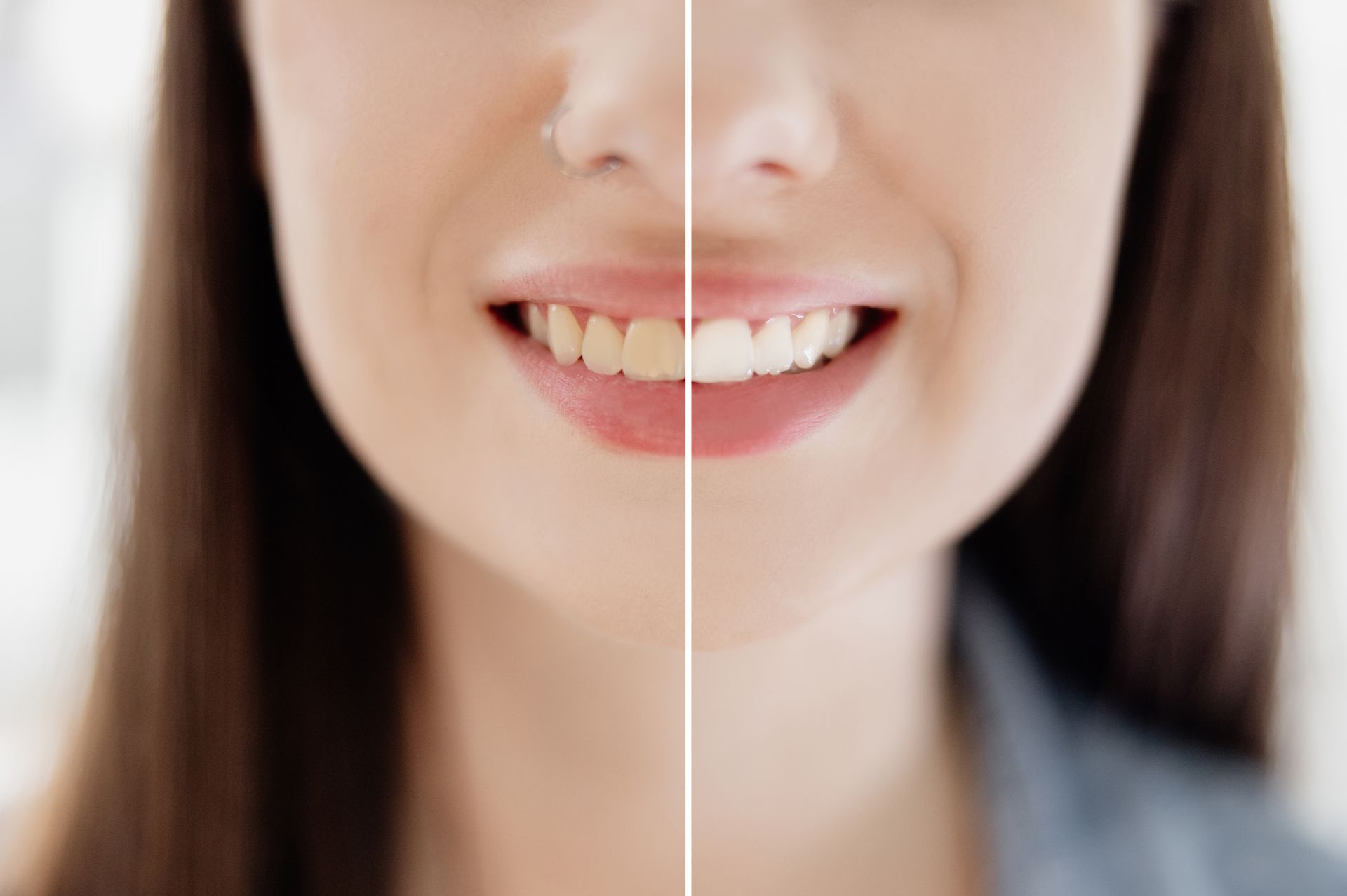 Woman's teeth before and after whitening Woman's teeth before and after whitening