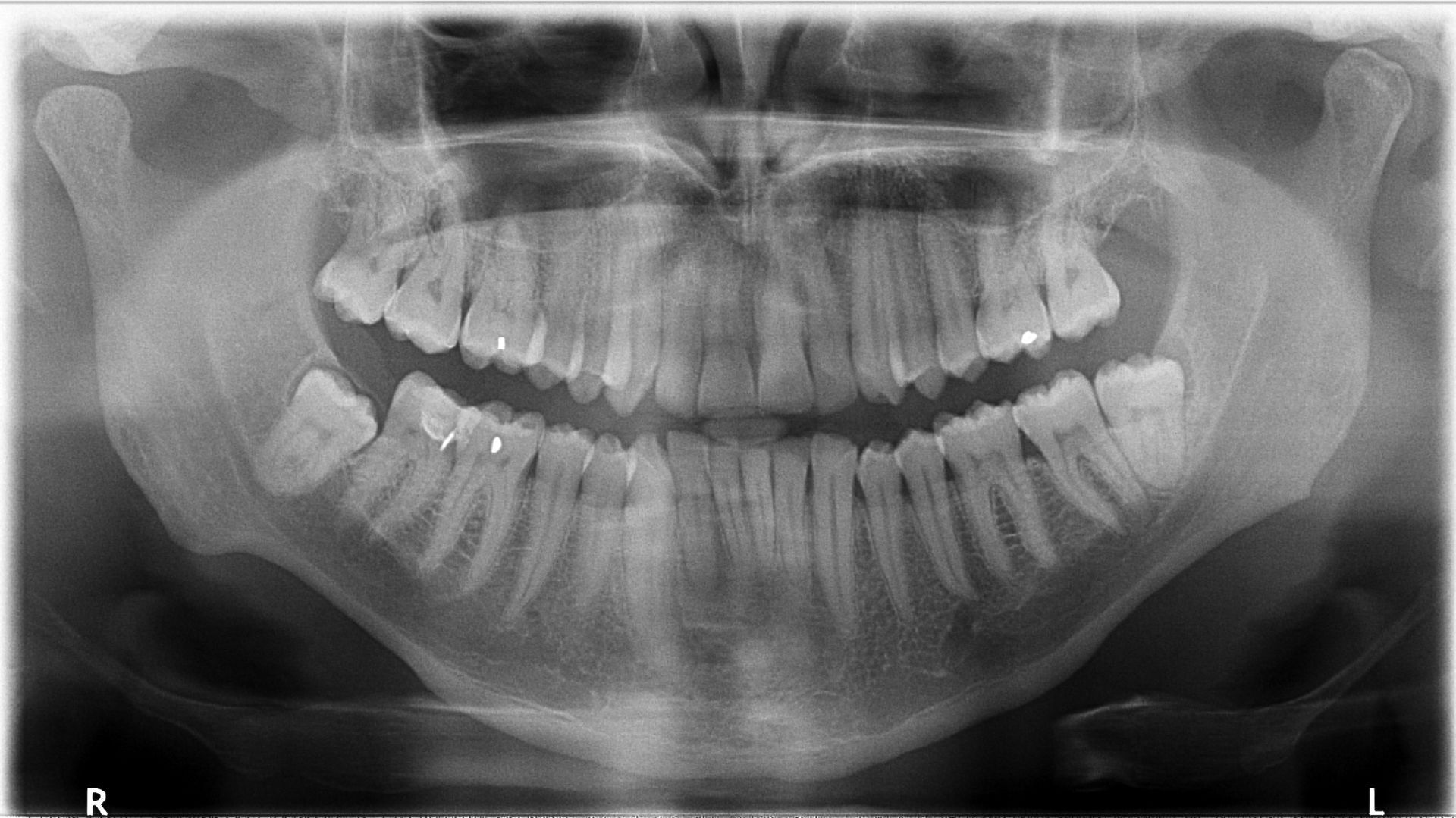 A dentist is looking at an x-ray of a patient 's teeth on a tablet.