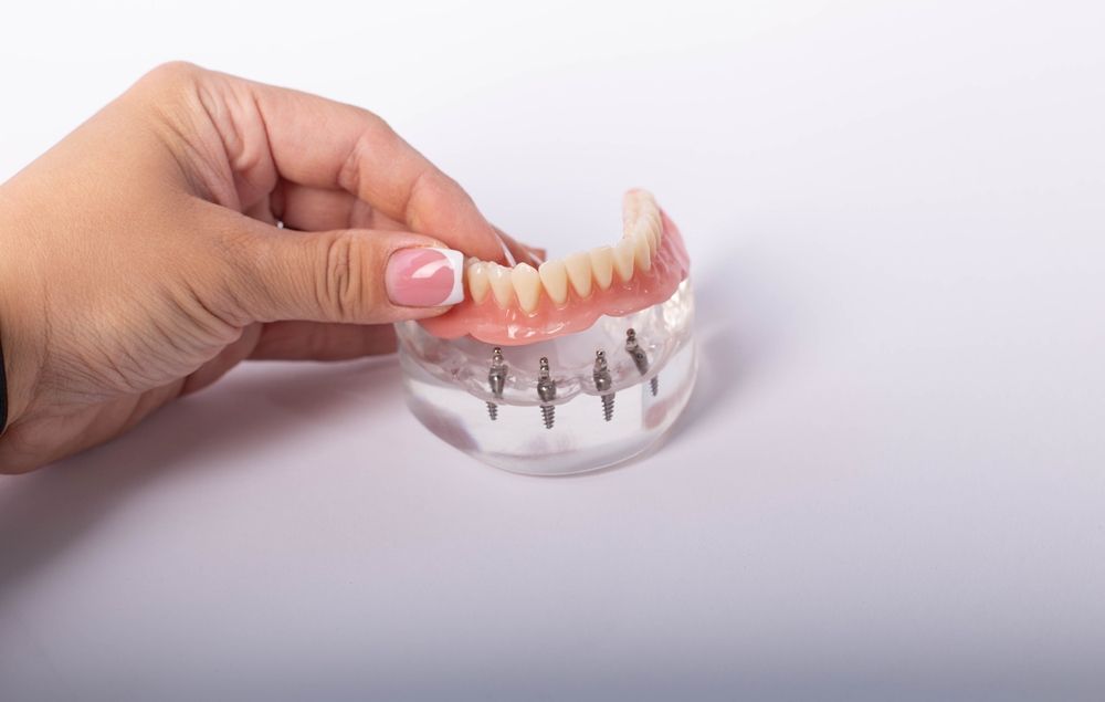 A Woman is Holding a Model of a Denture With Dental Implants — Dental Prosthetics By Richard & Cindy In Oxenford, QLD