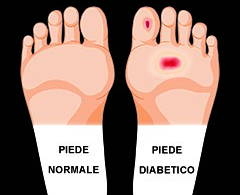 Una complicanza dovuta ai danni che il diabete mellito fa al corpo umano