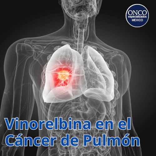 Imagen médica de un torso con un pulmón resaltado, relacionada con el uso de vinorelbina en cáncer de pulmón.
