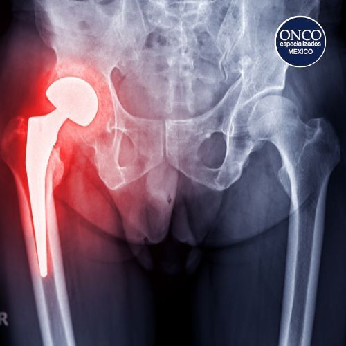 Radiografía mostrando fractura de cadera por osteoporosis.