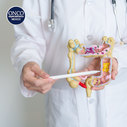 Modelo digestivo ilustrando la enfermedad de Crohn.