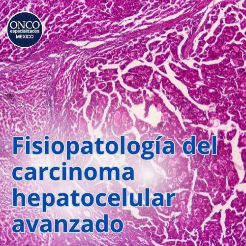 Imagen microscópica que muestra alteraciones en el hígado por carcinoma avanzado.